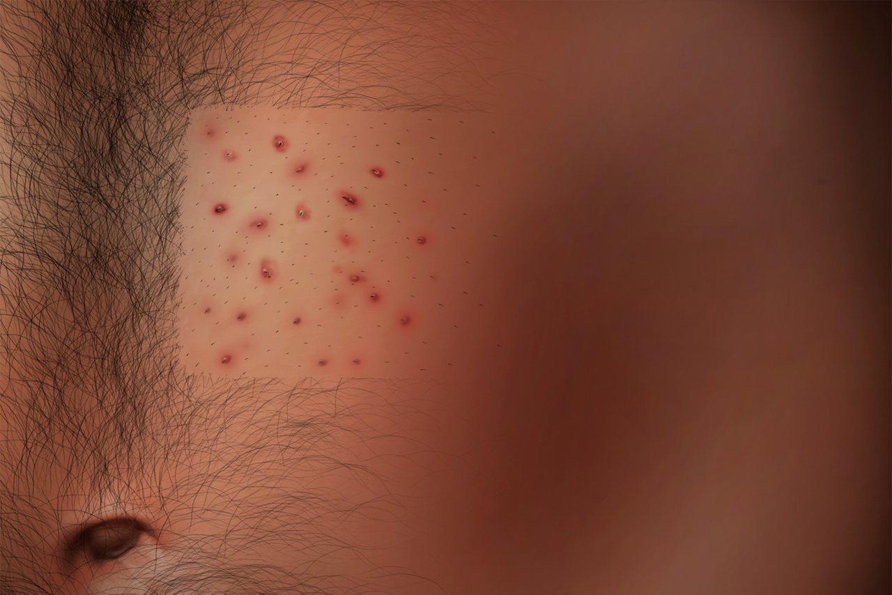 MARSI Folliculitis