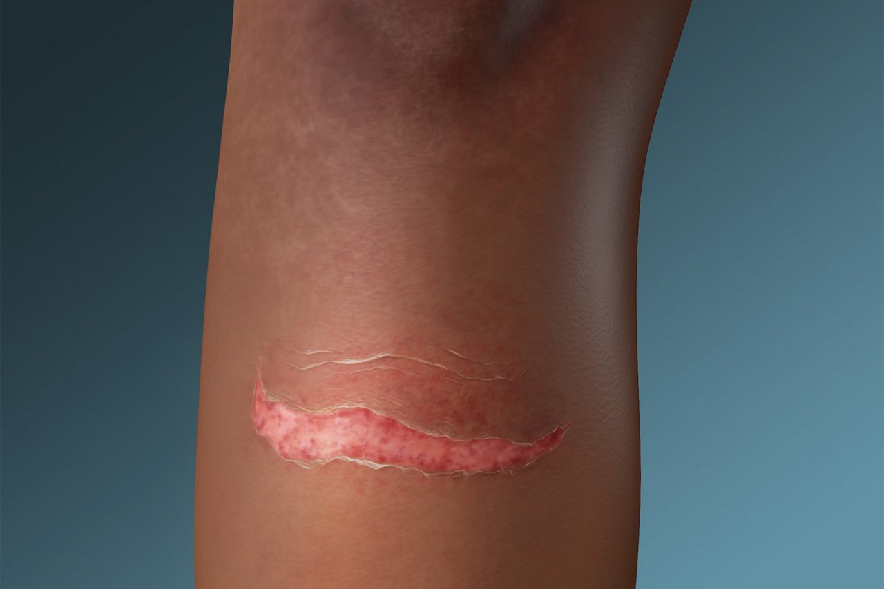 MARSI Skin Tear