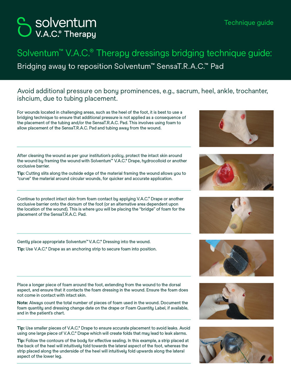 V.A.C.® Therapy Dressings Bridging Technique Guide