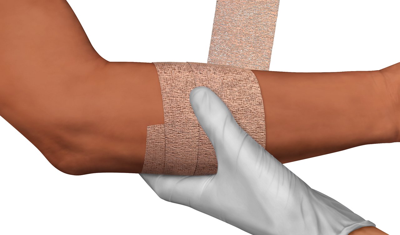 Clinician wrapping Coban™ NL Non-Latex Self-Adherent Wrap on patient's arm
