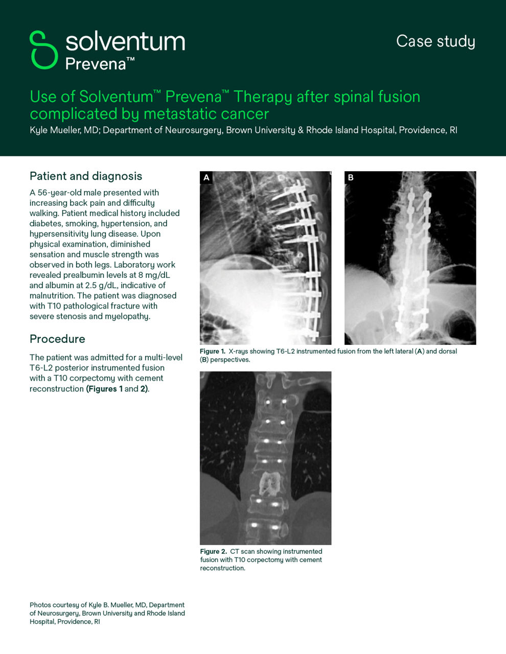 Prevena Therapie nach Wirbelsäulenfusion, kompliziert durch metastasierenden Krebs Fallstudie Vorschau