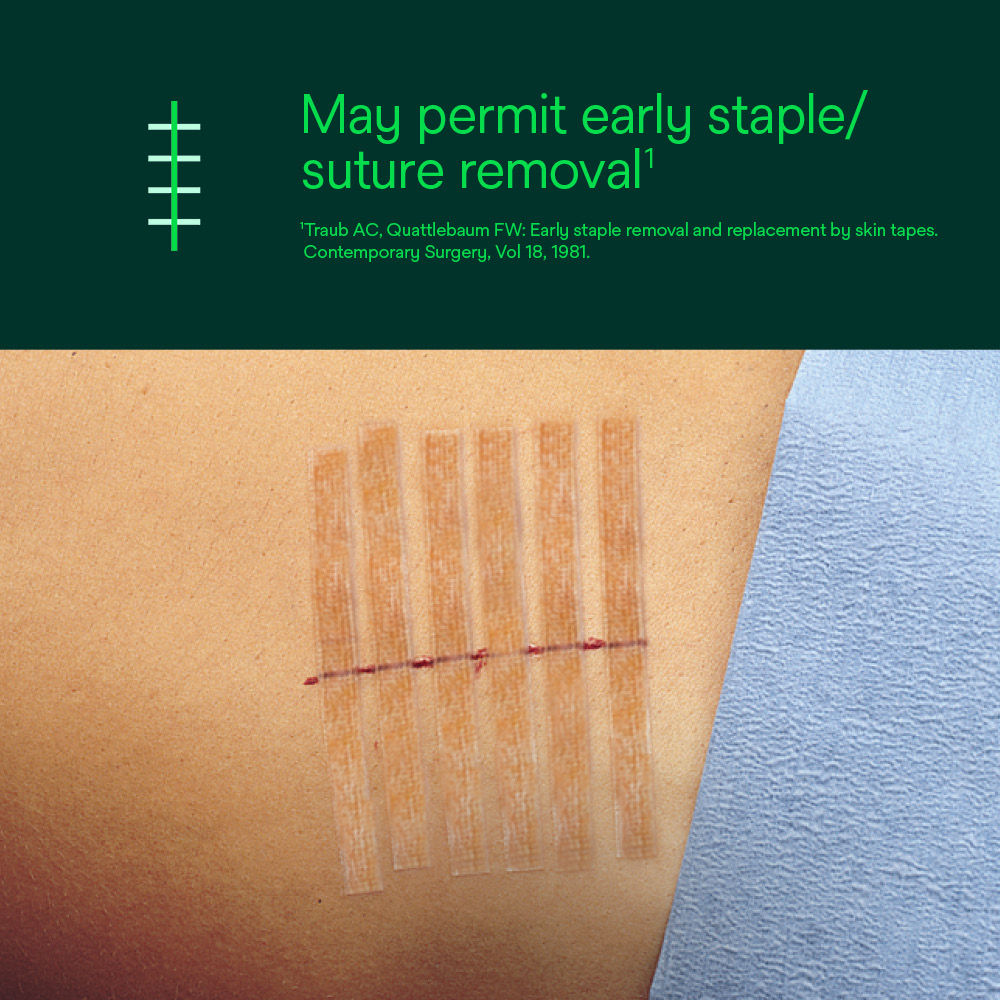 Steri-Strip Antimicrobial Skin Closure – May Permit Early Suture Removal