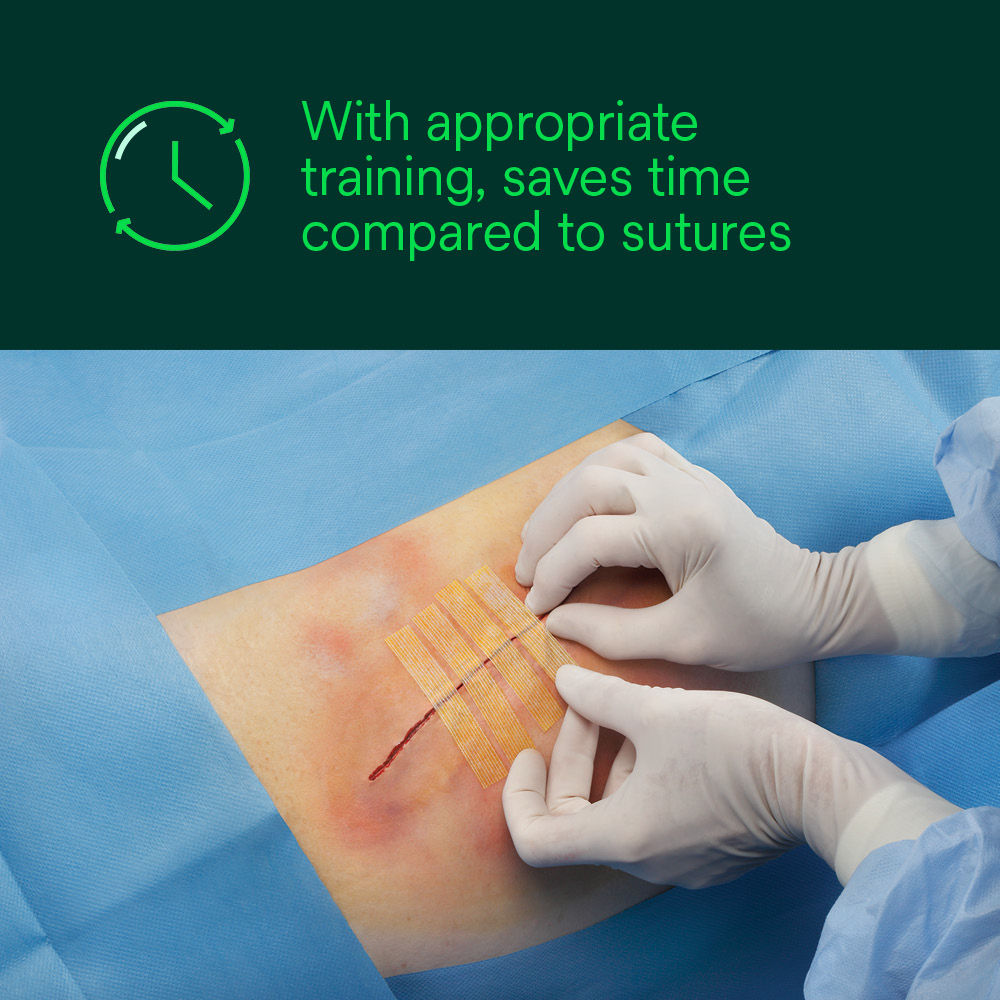 Steri-Strip Antimicrobial Skin Closure – Saves Time Compared to Sutures