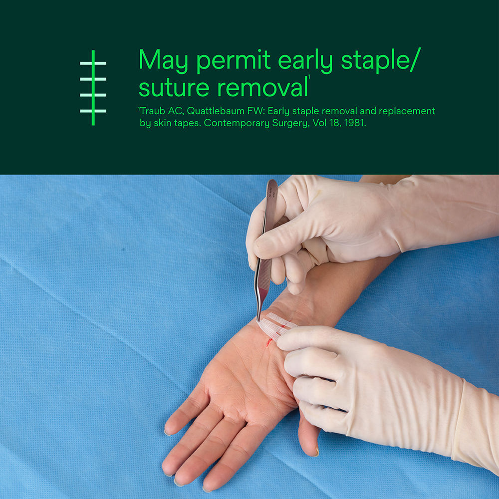 Steri-Strip Reinforced Skin Closure – May Permit Early Suture Removal