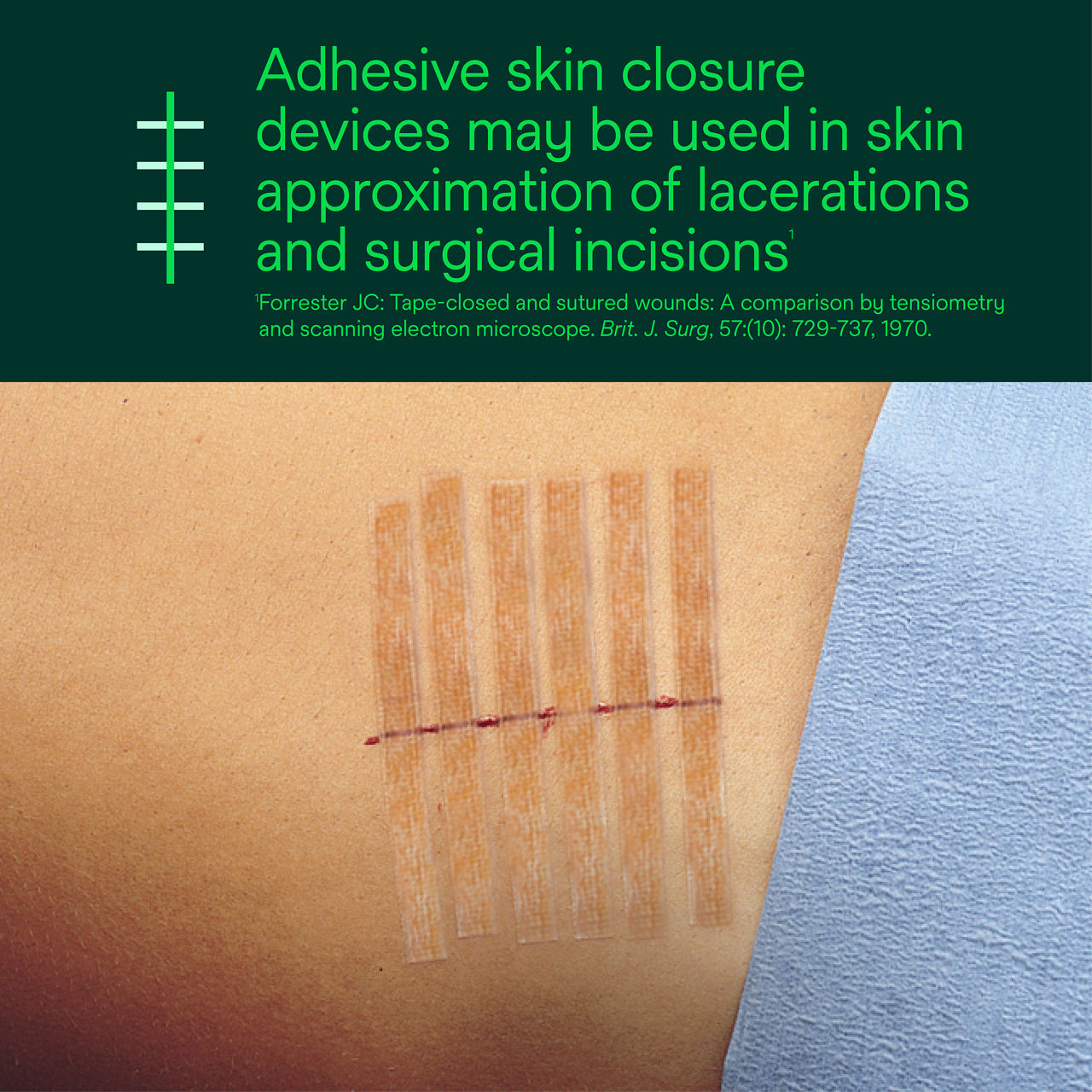 Steri-Strip Reinforced Skin Closure – For Lacerations and Surgical Incisions