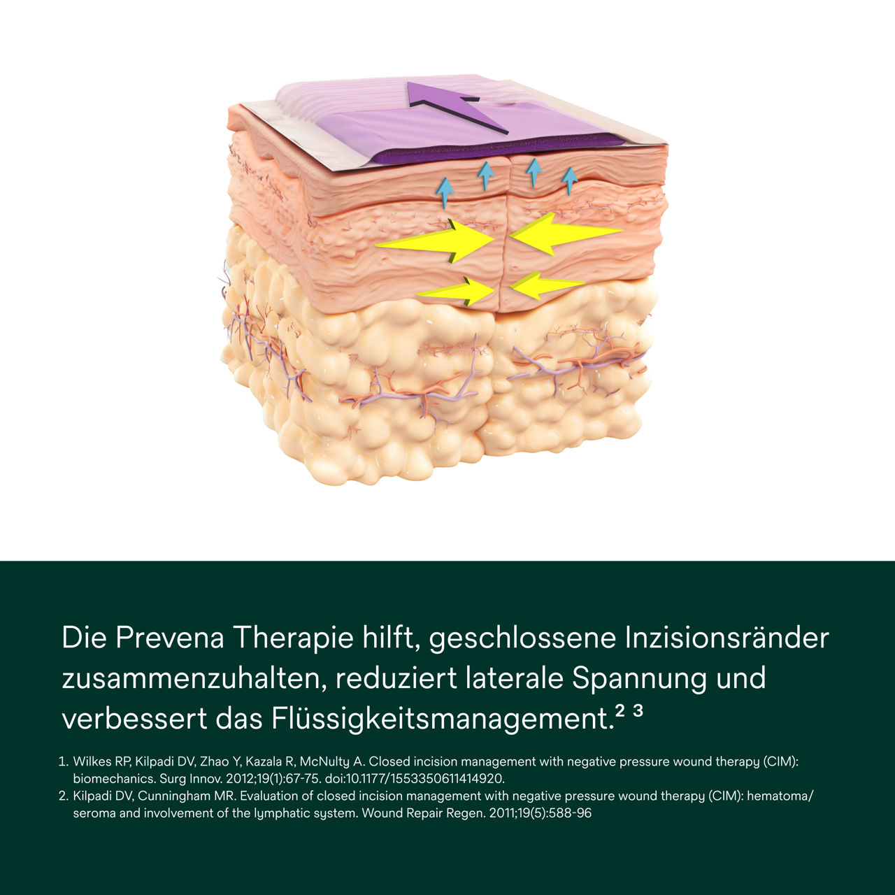 Prevena Peel and Place Verband – PDP-Bild 1