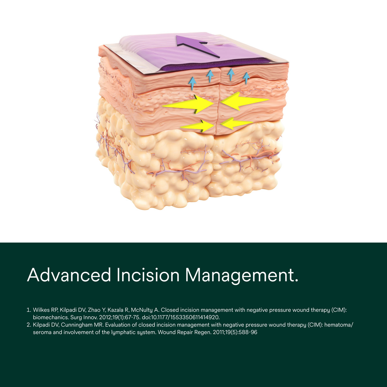 Prevena Peel and Place Dressing - PDP Image 1