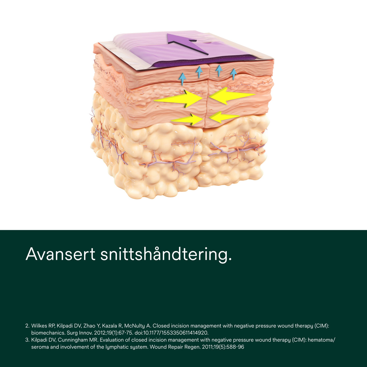 Prevena Peel and Place-verband - PDP-afbeelding 1