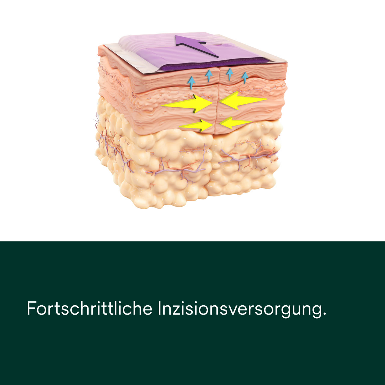 Prevena Peel and Place System – PDP-Bild 1