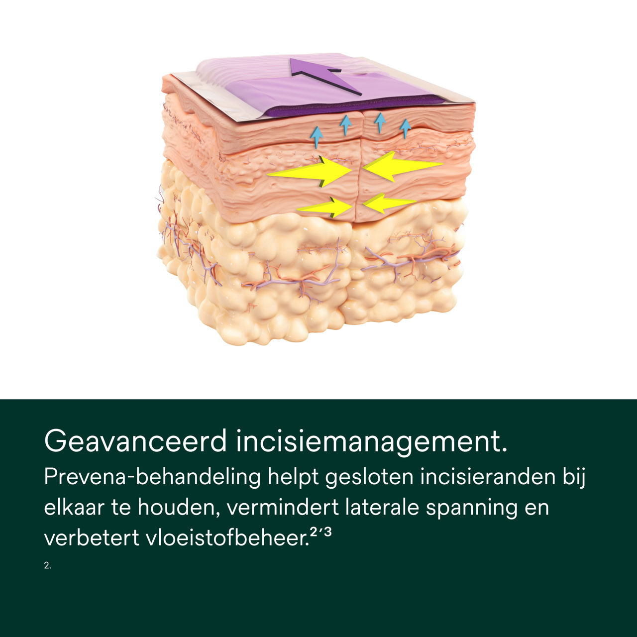 Prevena Peel and Place-systeem - PDP-afbeelding 1