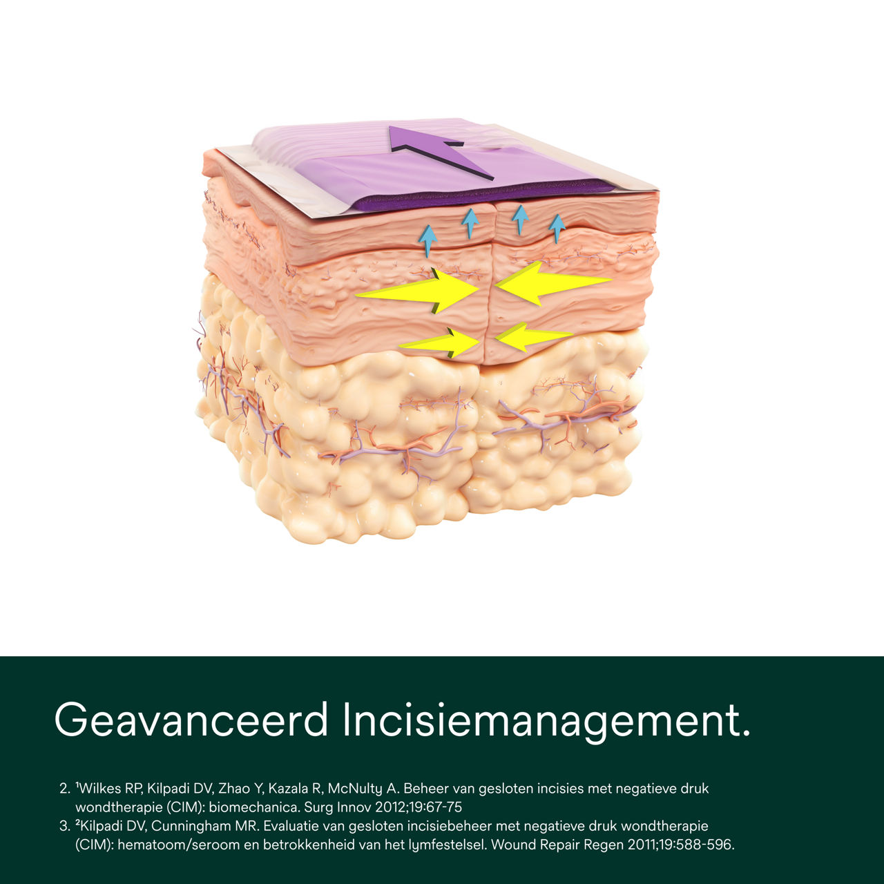 Prevena Plus aanpasbaar verband - PDP-afbeelding 1