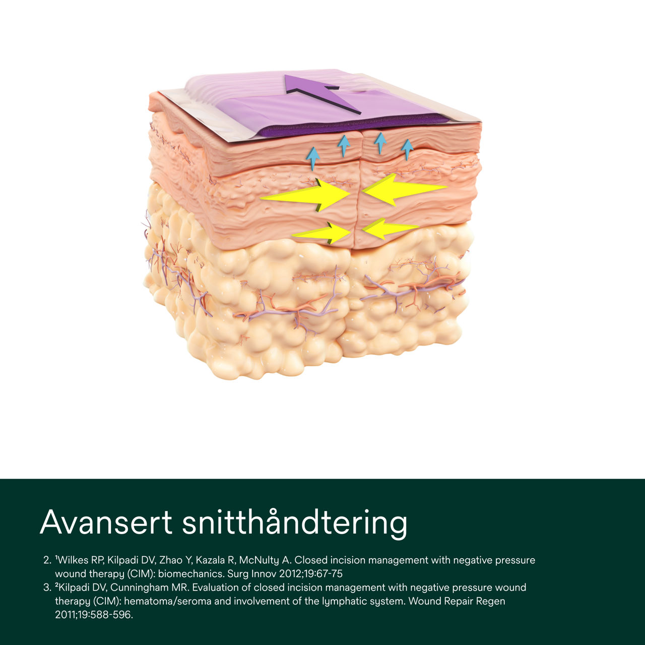 Prevena Plus aanpasbaar verband - PDP-afbeelding 1