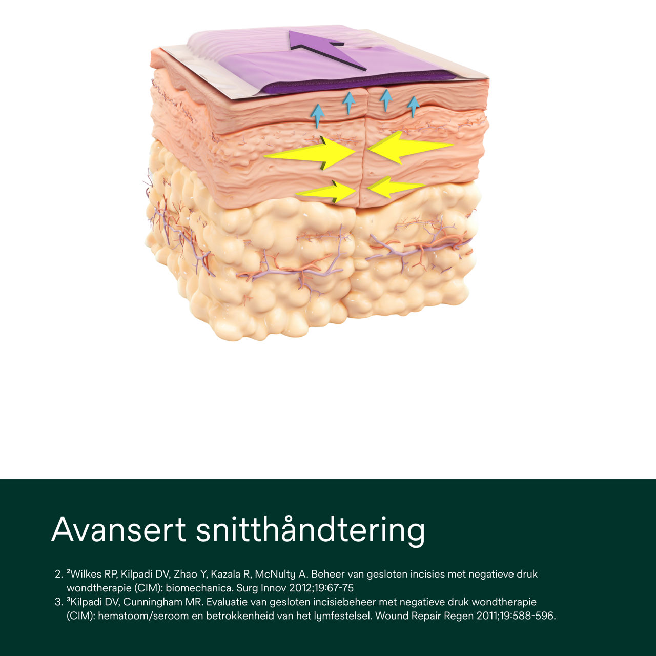 Prevena Plus aanpasbare kit - PDP-afbeelding 1