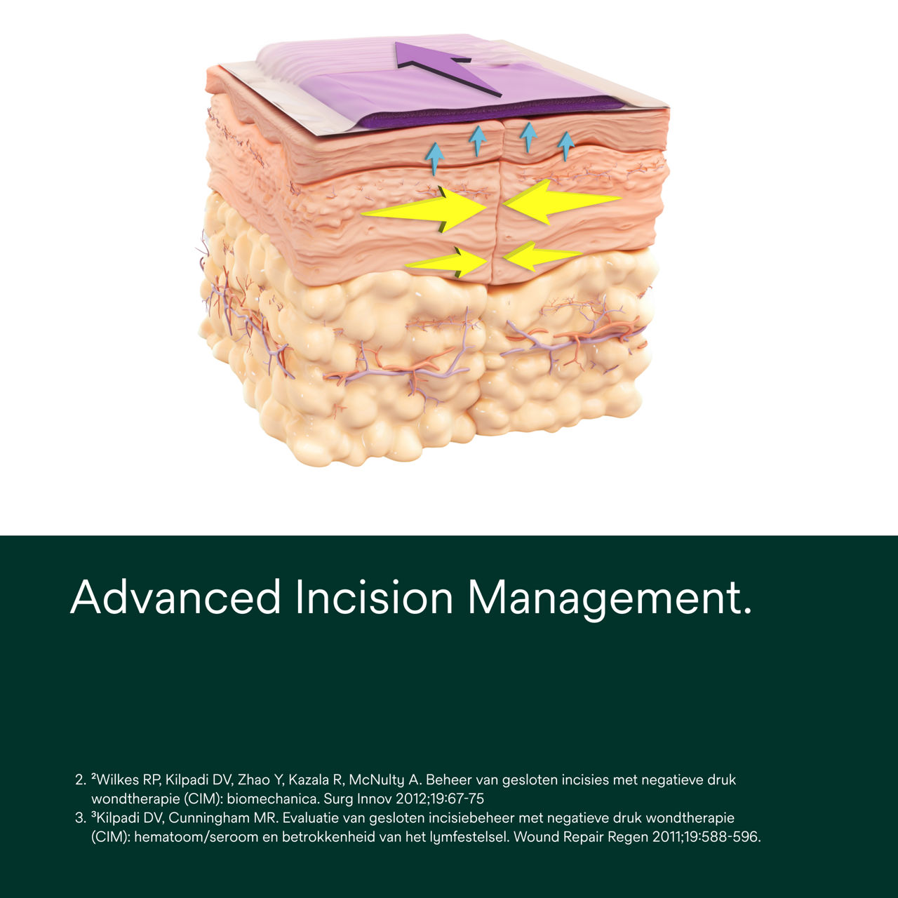 Prevena Plus Customizable Kit - PDP Image 1