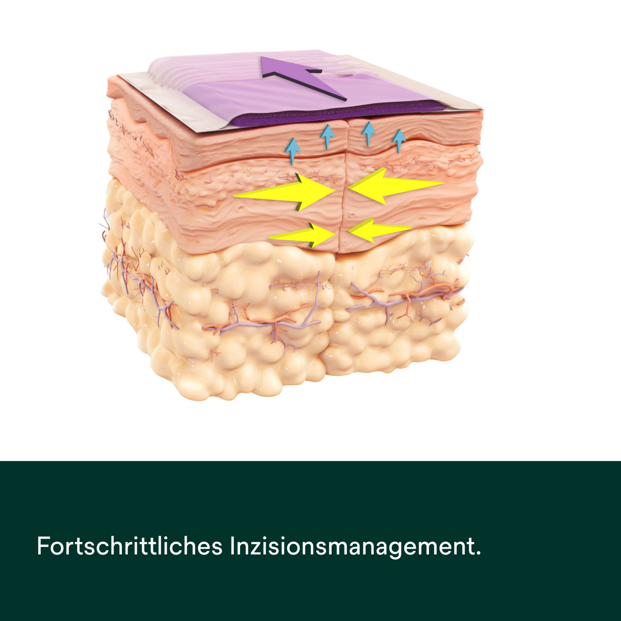 Prevena Restor Bella Form Verband – PDP Bild 4