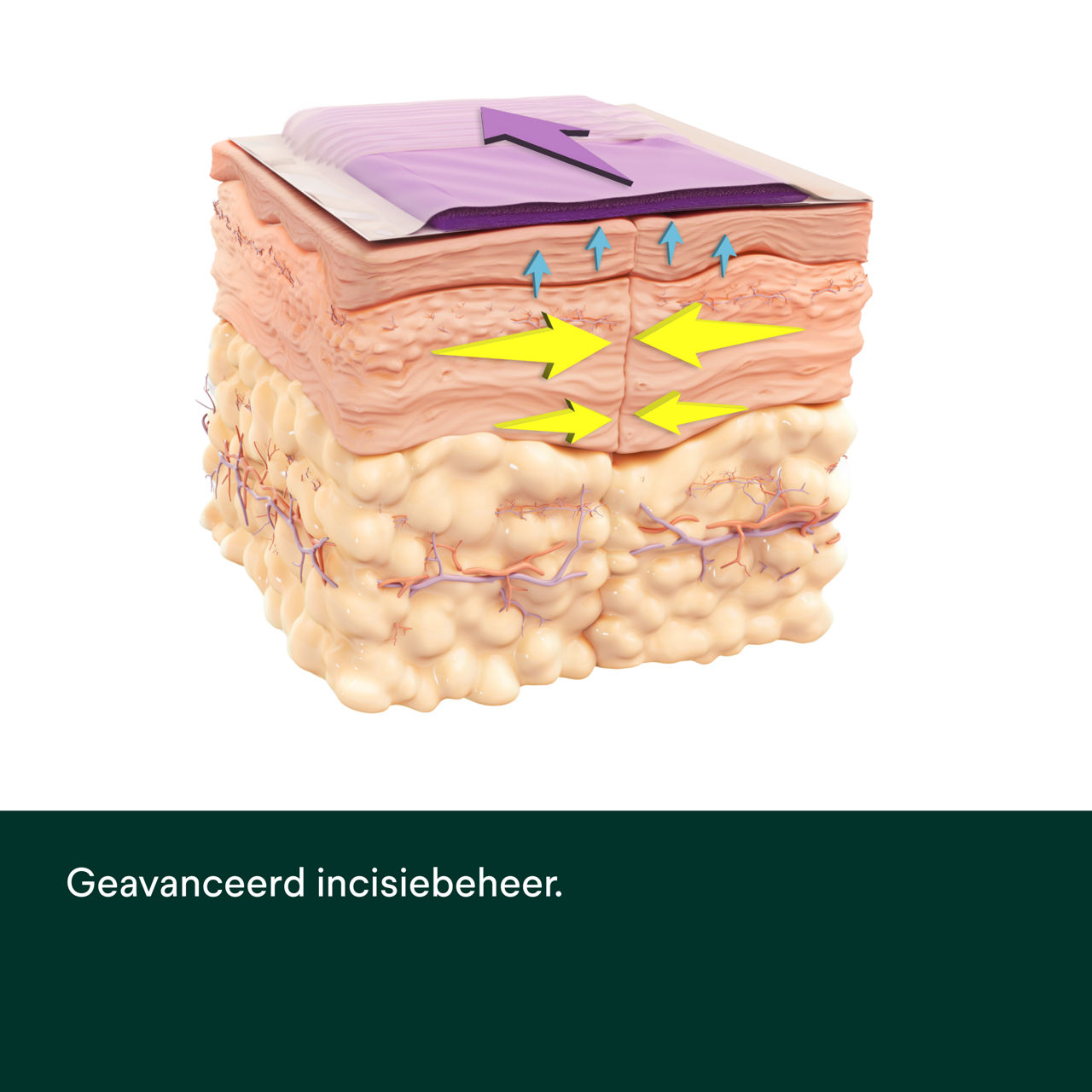 Prevena Restor Bella Form-verband - PDP-afbeelding 4