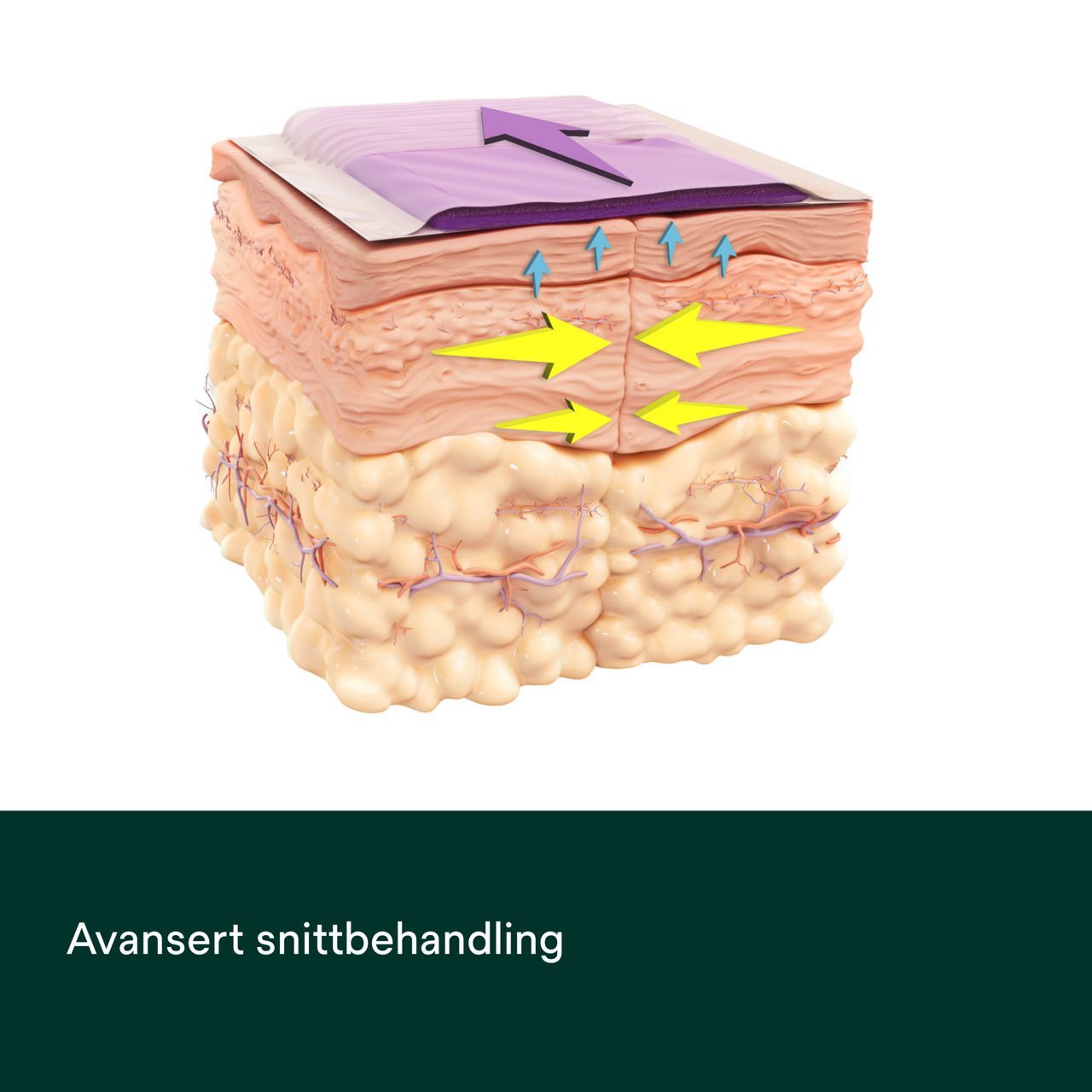 Prevena Restor Bella Form-verband - PDP-afbeelding 4