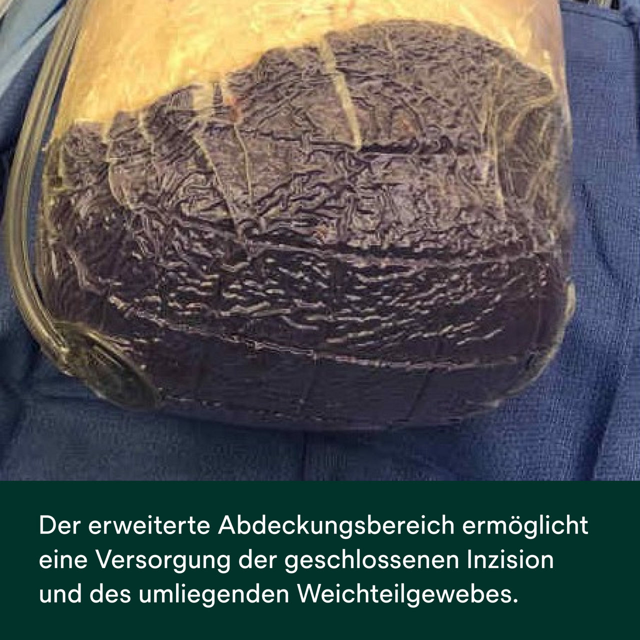 Prevena Restor Bella Form Verband – PDP-Bild 5