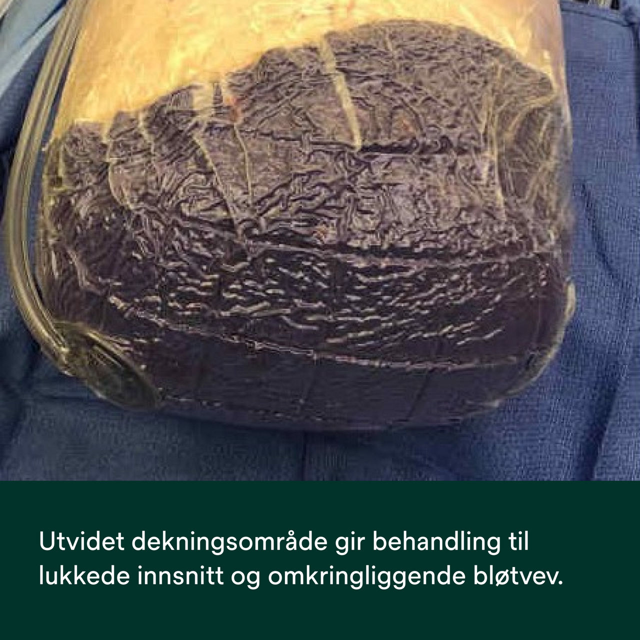 Prevena Restor Bella Form-verband - PDP-afbeelding 5