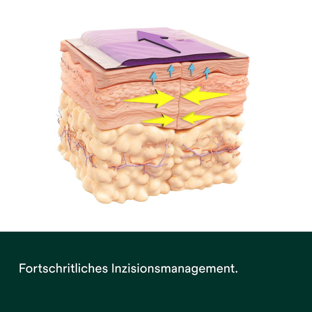 Prevena Restor Bella Form System – PDP-Bild 4