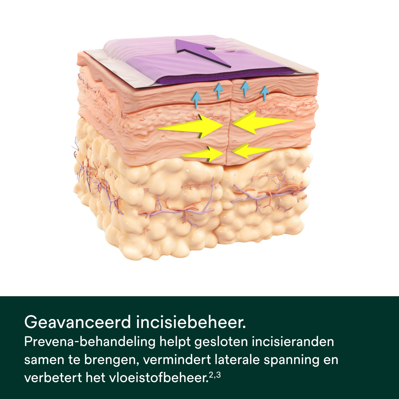 Prevena Restor Bella Form-systeem - PDP-afbeelding 4