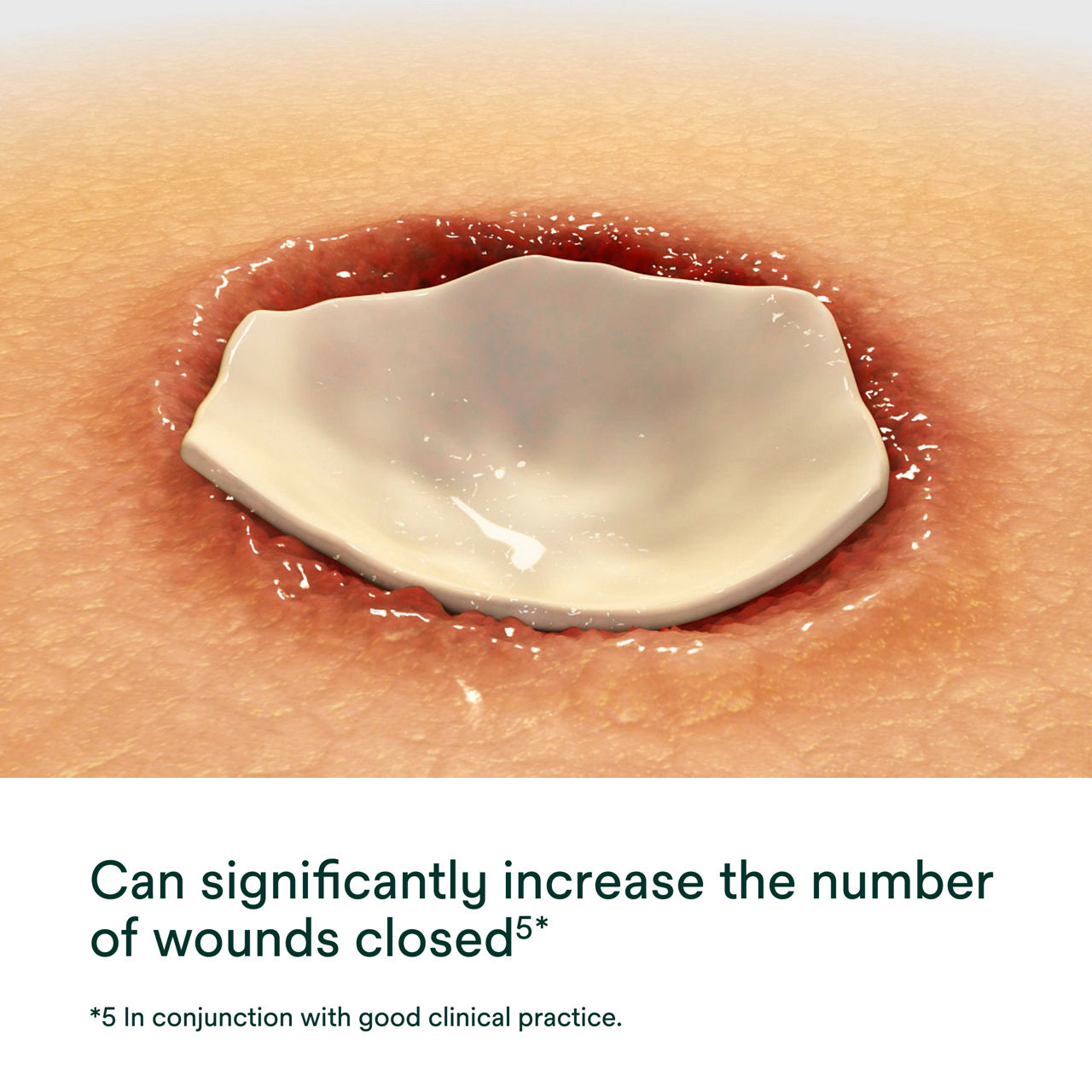 Promogran Collagen Matrix with Orc Secondary Image 1