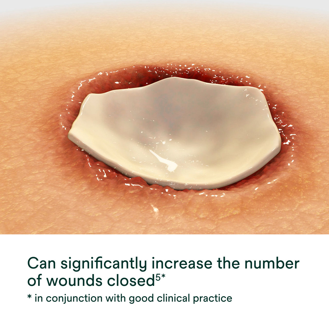 Promogran Prisma Collagen Matrix with Orc and Silver PDP Secondary Image 1