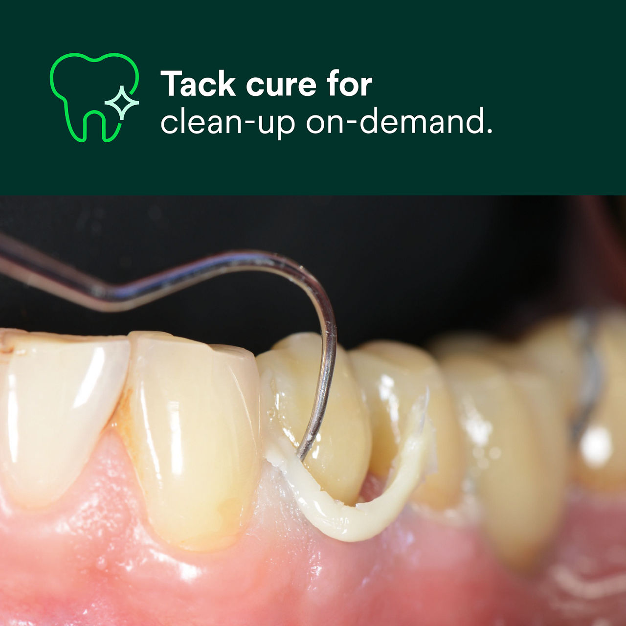 (1) RelyX Luting Plus RMGI Cement: Tack cure for clean-up on-demand