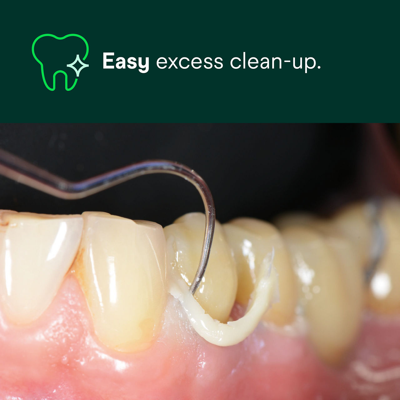 (1) RelyX Universal Resin Cement: Easy excess clean-up