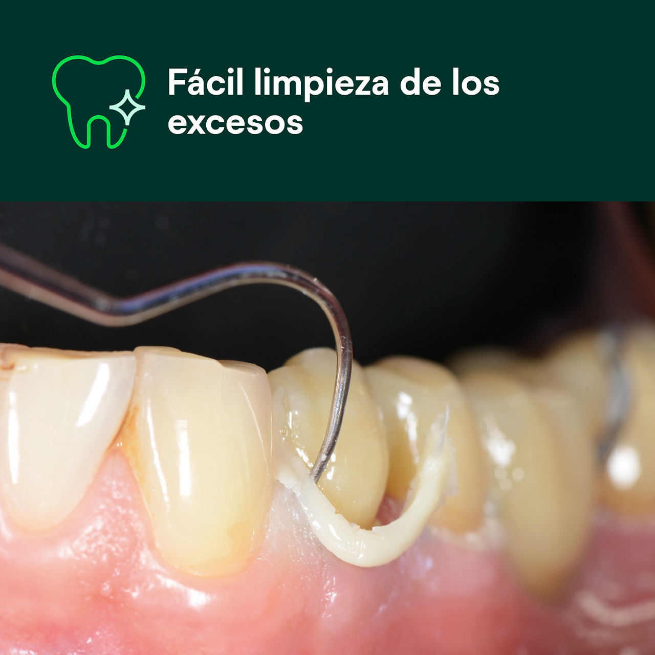 (1) Cimento de resina RelyX™ Universal cemento: Fácil retirada del exceso.