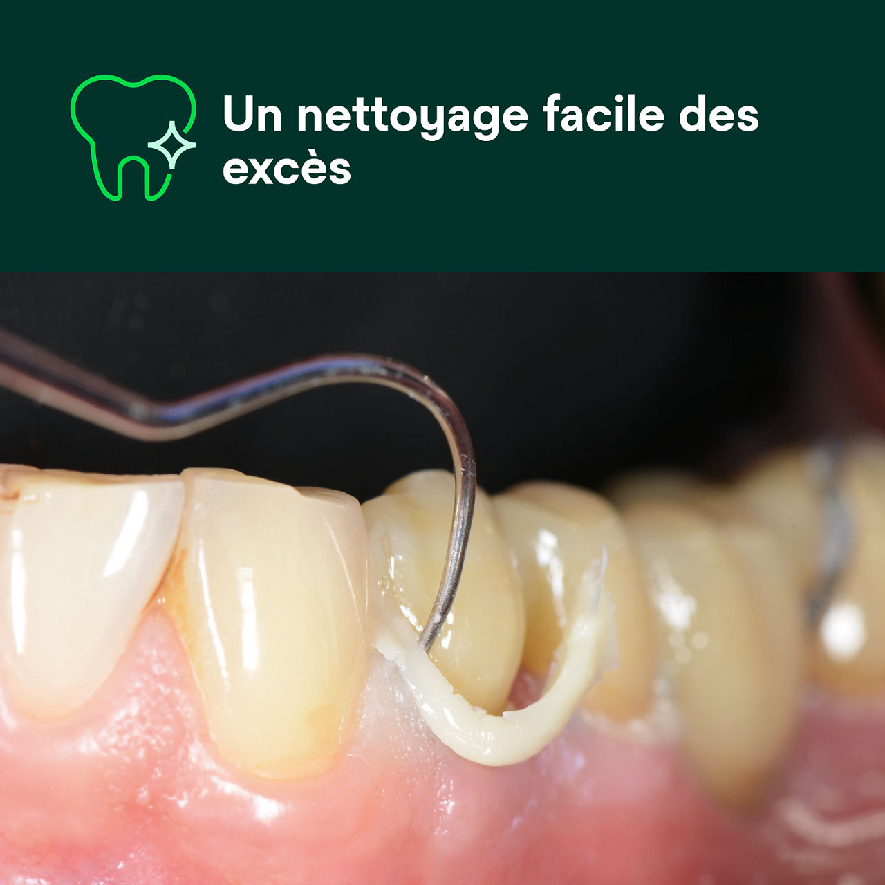 (1) RelyX™ Universal Ciment-composite de collage: Facilite le nettoyage des excès.