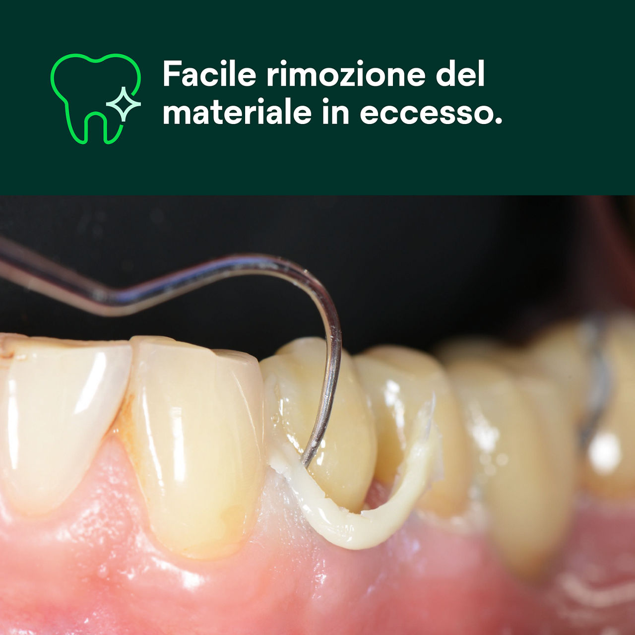 (1) RelyX™ Universal cemento composito : Facile rimozione del materiale in eccesso.
