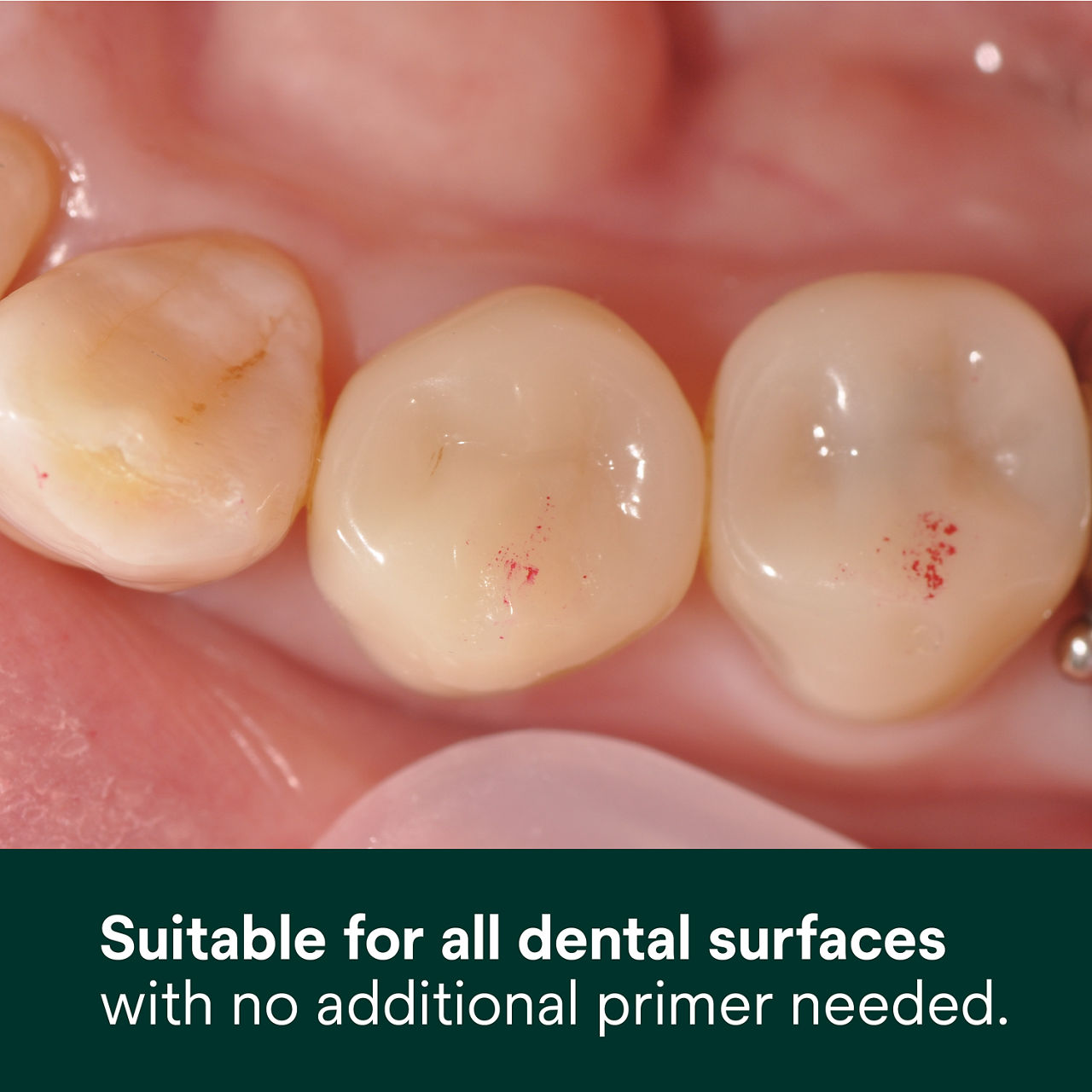 (1) Scotchbond Universal Adhesive: Suitable for all dental surfaces with no additional primer needed