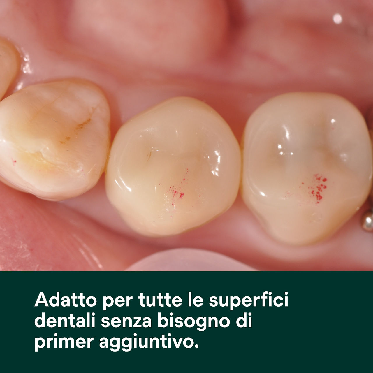 (1) Scotchbond Adesivo Universale: Adatto per tutte le superfici dentali senza bisogno di primer aggiuntivo