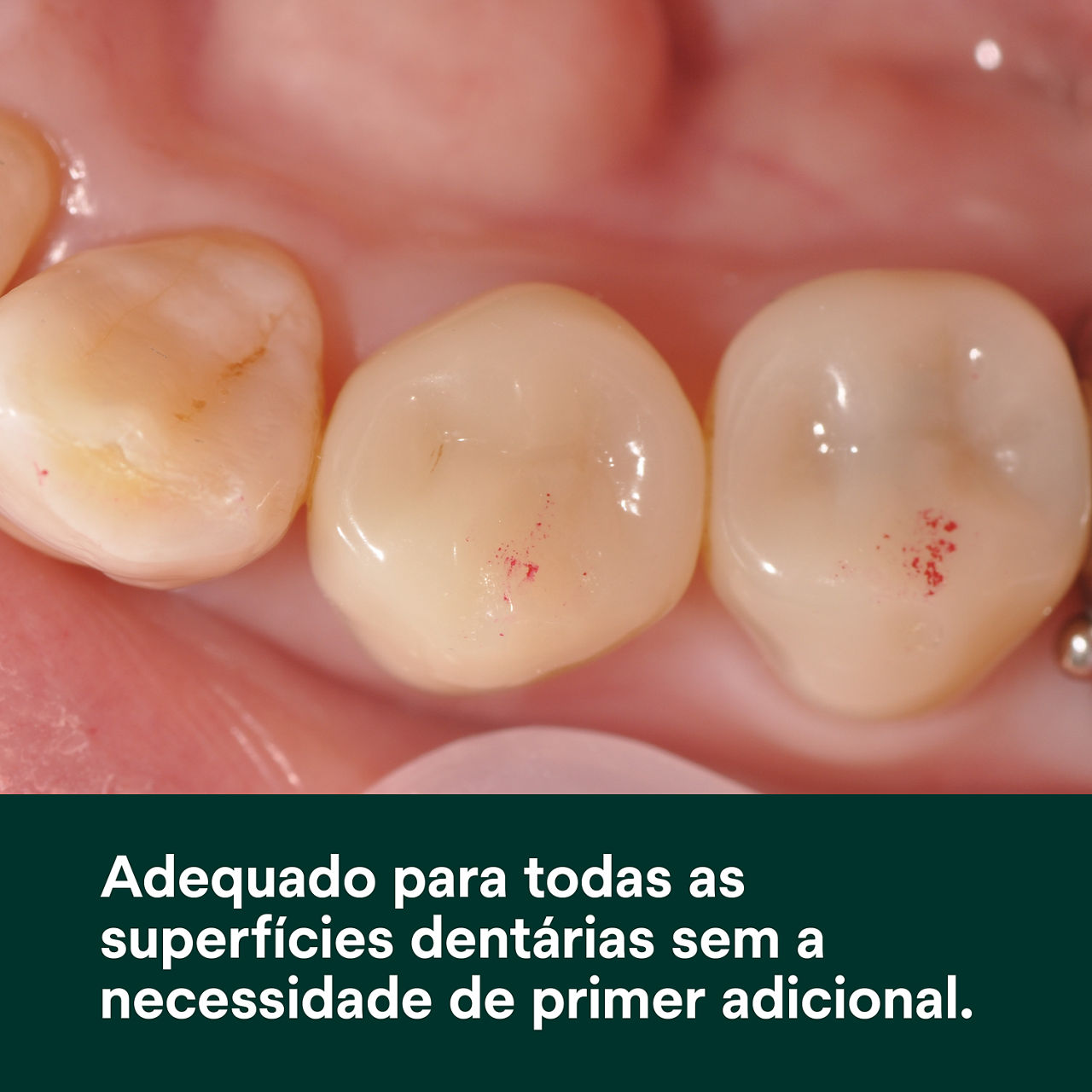 (1) Scotchbond Adesivo Universal: Adequado para todas as superfícies dentárias, sem necessidade de primer adicional