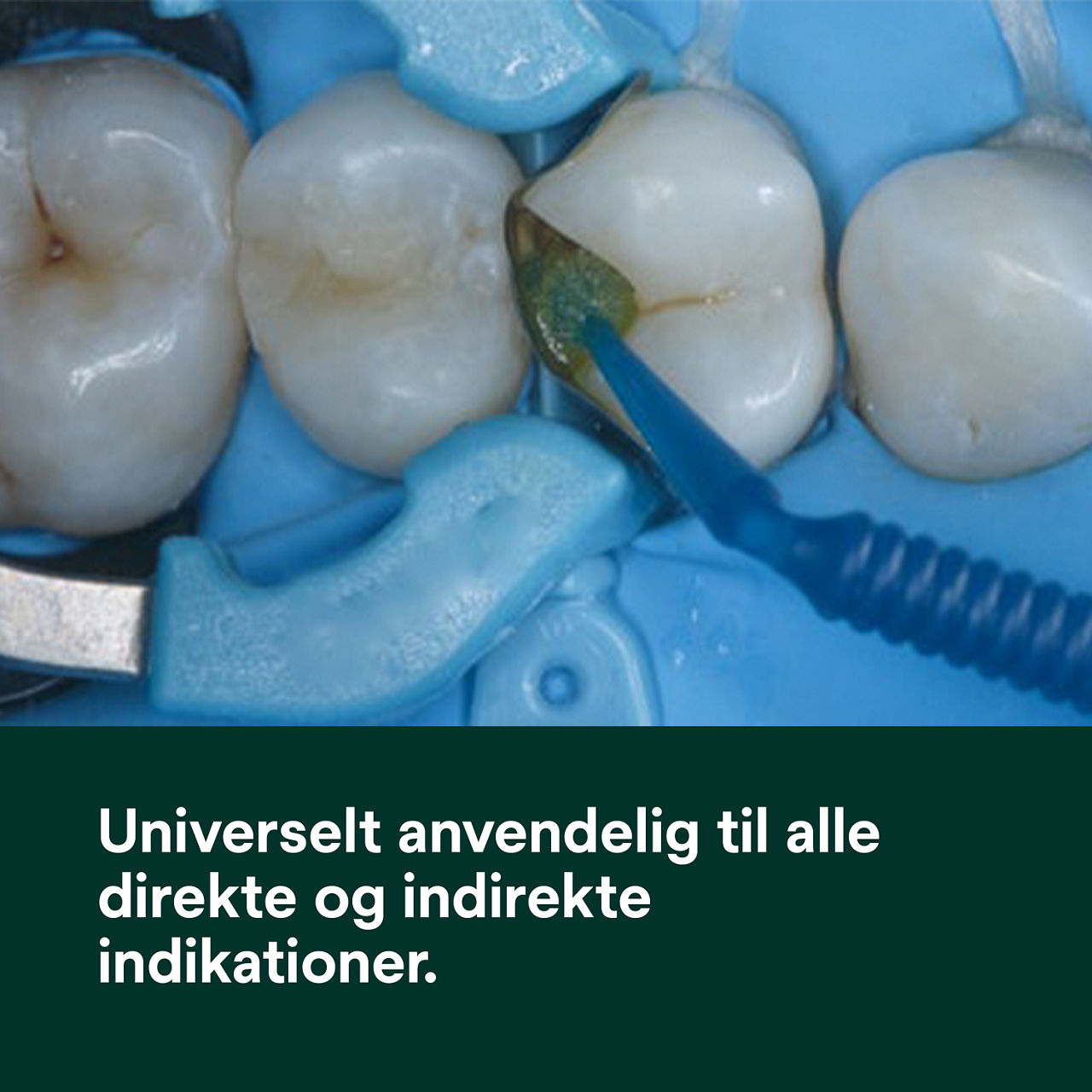 (1) Scotchbond Universal Plus Lim: Universelt egnet til alle direkte og indirekte indikationer