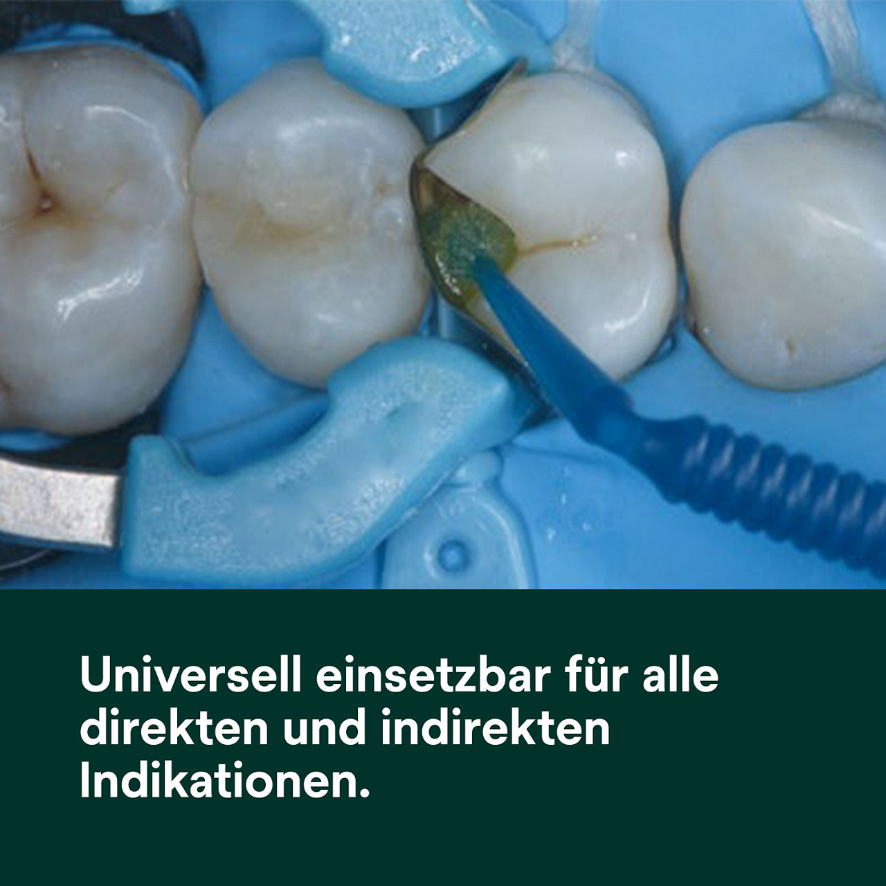 (1) ScotchBond™ Universal Plus Klebstoff: Universell geeignet für alle Indikationen