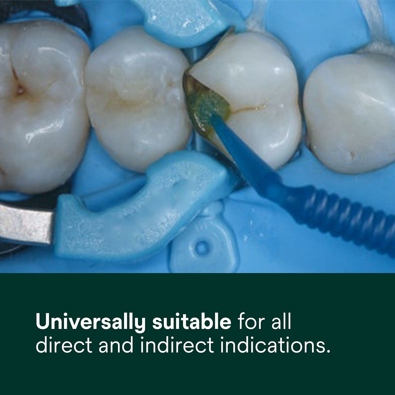 (1) Scotchbond Universal Plus Adhesive: Universally suitable for all direct and indirect indications