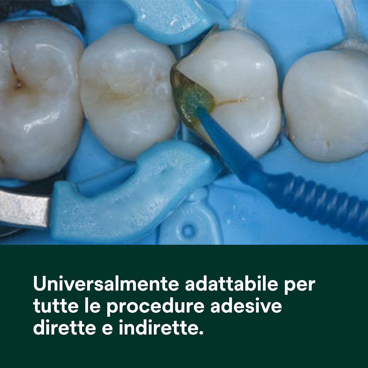 (1) Scotchbond Adesivo Universale Plus: Universalmente adatto per tutte le indicazioni dirette e indirette