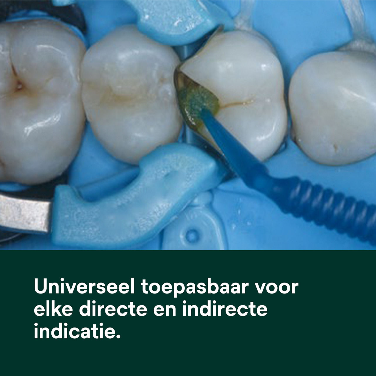 (1) Scotchbond Universal Plus Adhesief: Universeel geschikt voor alle directe en indirecte indicaties.