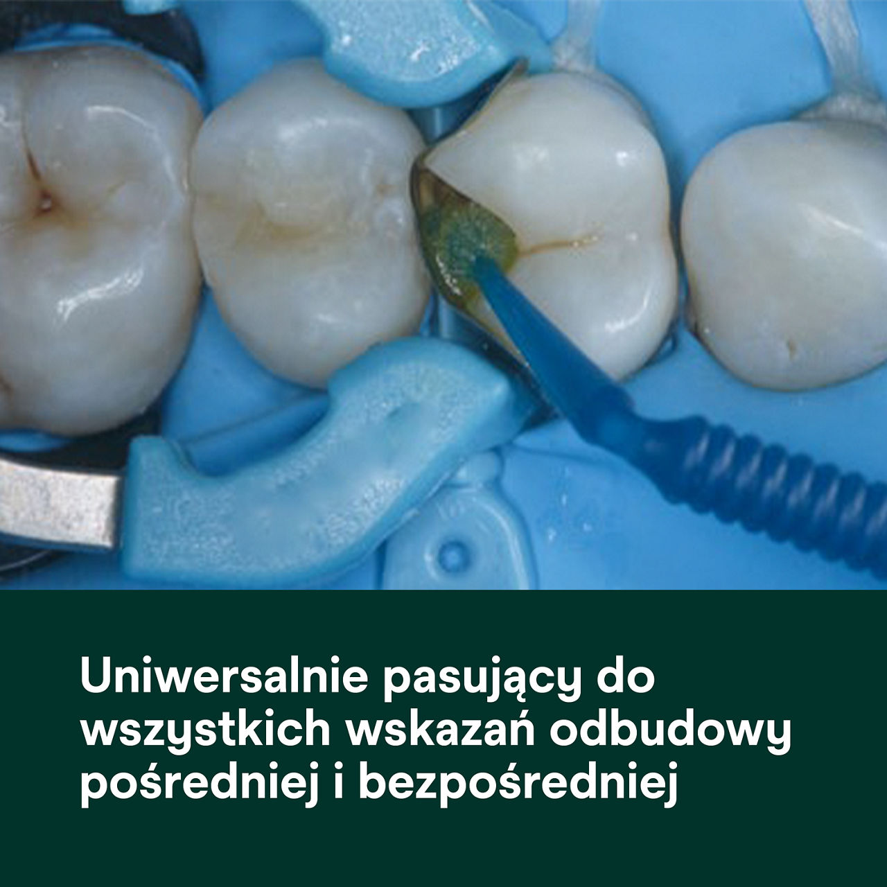 (1) ScotchBond™ Universal Adhesive Plus: Uniwersalny klej  bezpośrednich i pośrednich wskazań