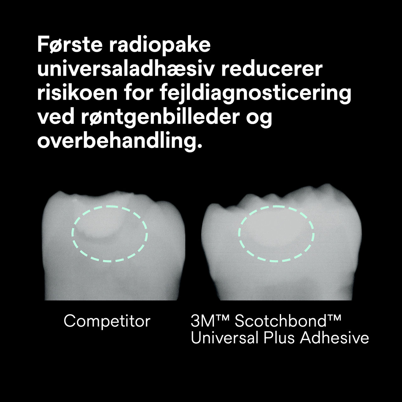 (2) Scotchbond Universal Plus Lim: Første radiopaque universal lim reducerer risikoen ved røntgen