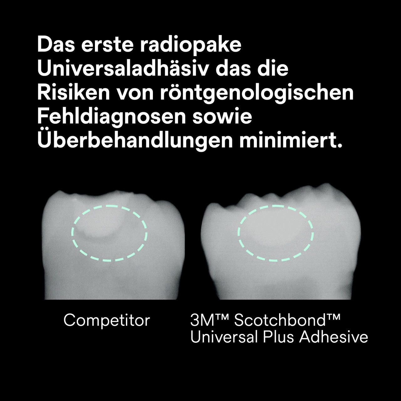 (2) ScotchBond™ Universal Plus Klebstoff: Erster röntgensichtbarer Universal-Klebstoff
