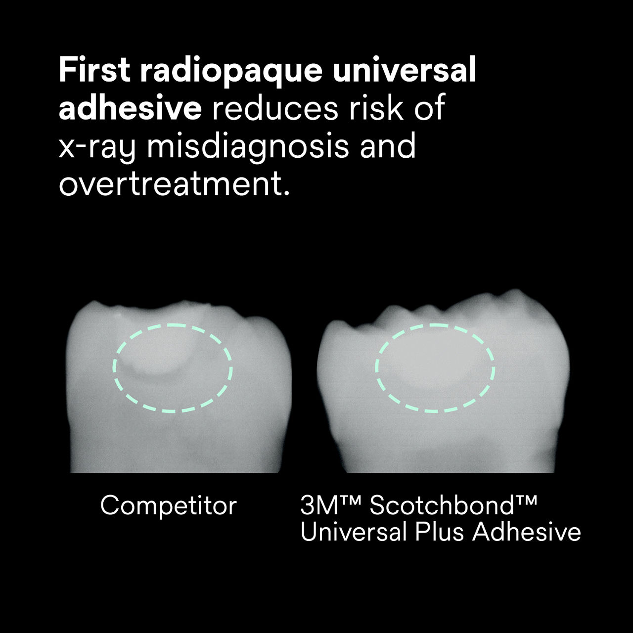 (2) Scotchbond Universal Plus Adhesive: First radiopaque universal adhesive reduces risk of x-ray