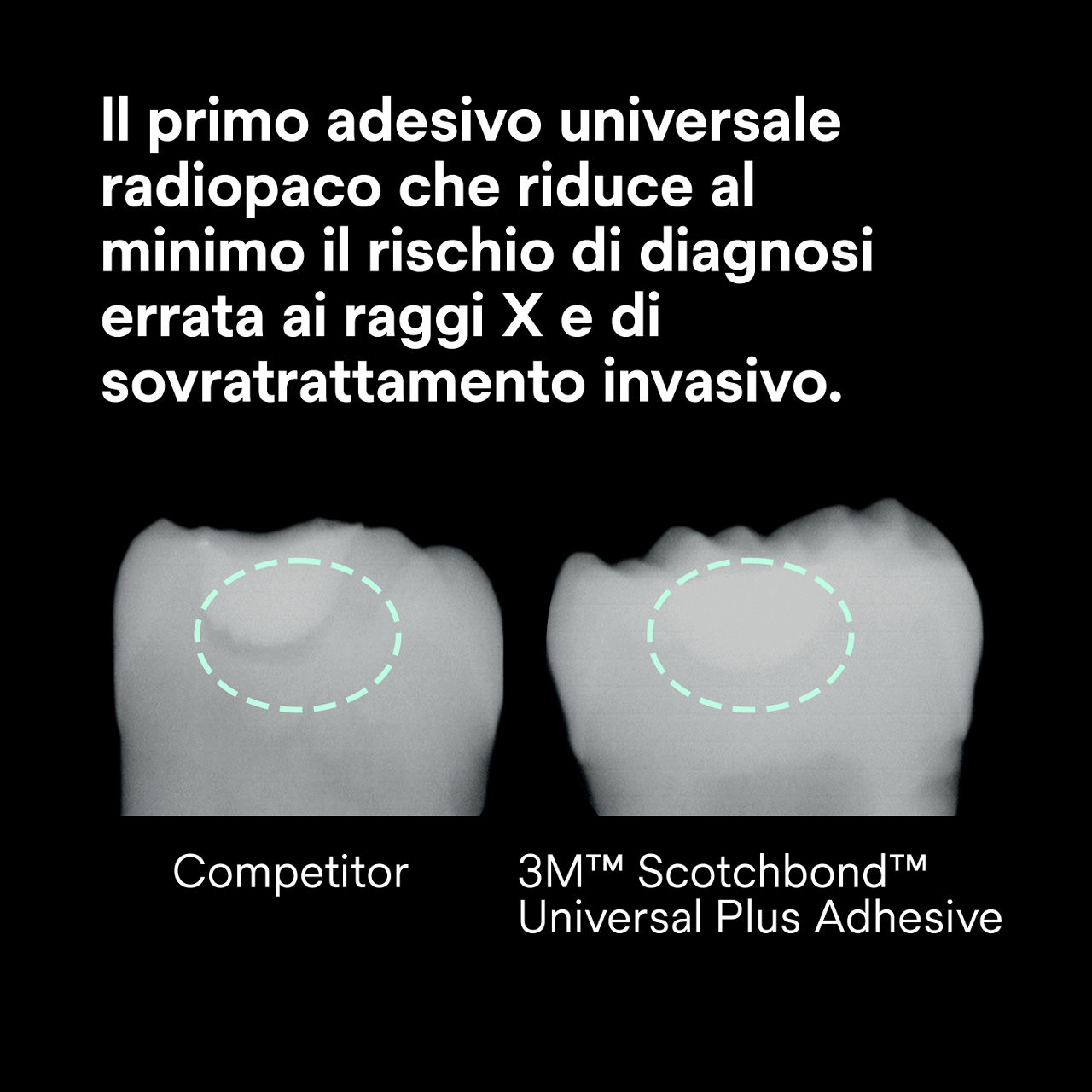 (2) Scotchbond Adesivo Universale Plus: Primo adesivo universale radiopaco che riduce il rischio con i raggi X
