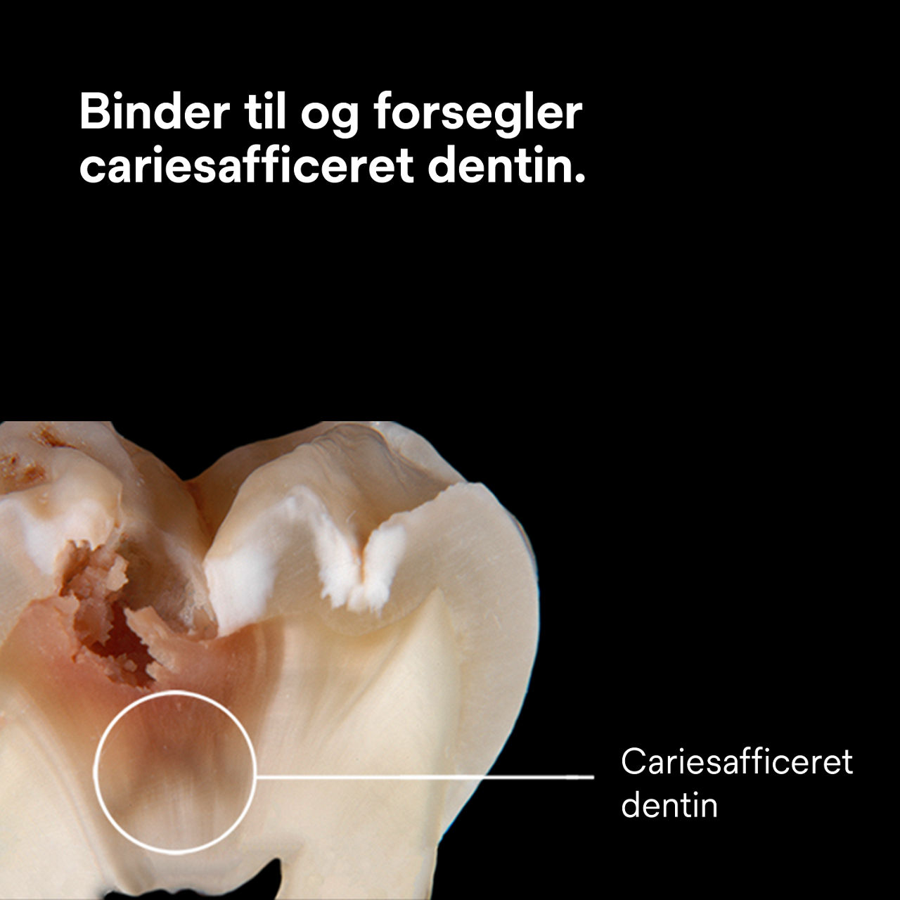 (3) Scotchbond Universal Plus Lim: Binder og forsegler caries-berørt dentin