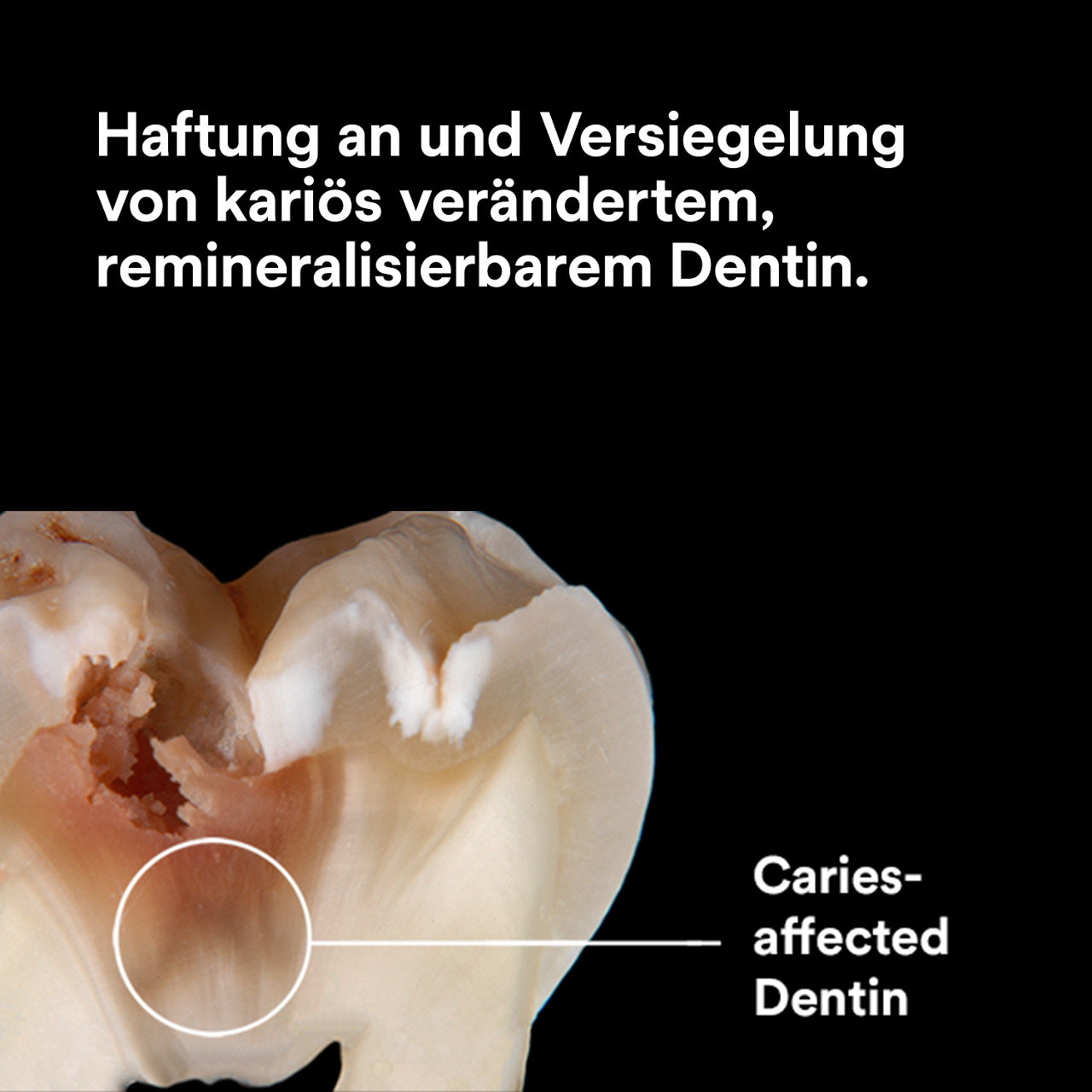 (3) ScotchBond™ Universal Plus Klebstoff: Bindet und versiegelt kariesbetroffenes Dentin