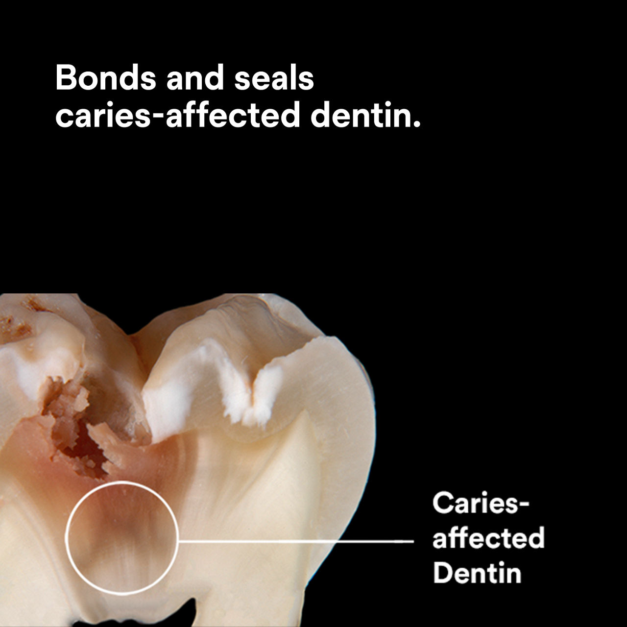 (3) Scotchbond Universal Plus Adhesive: Bonds and seals caries-affected dentin