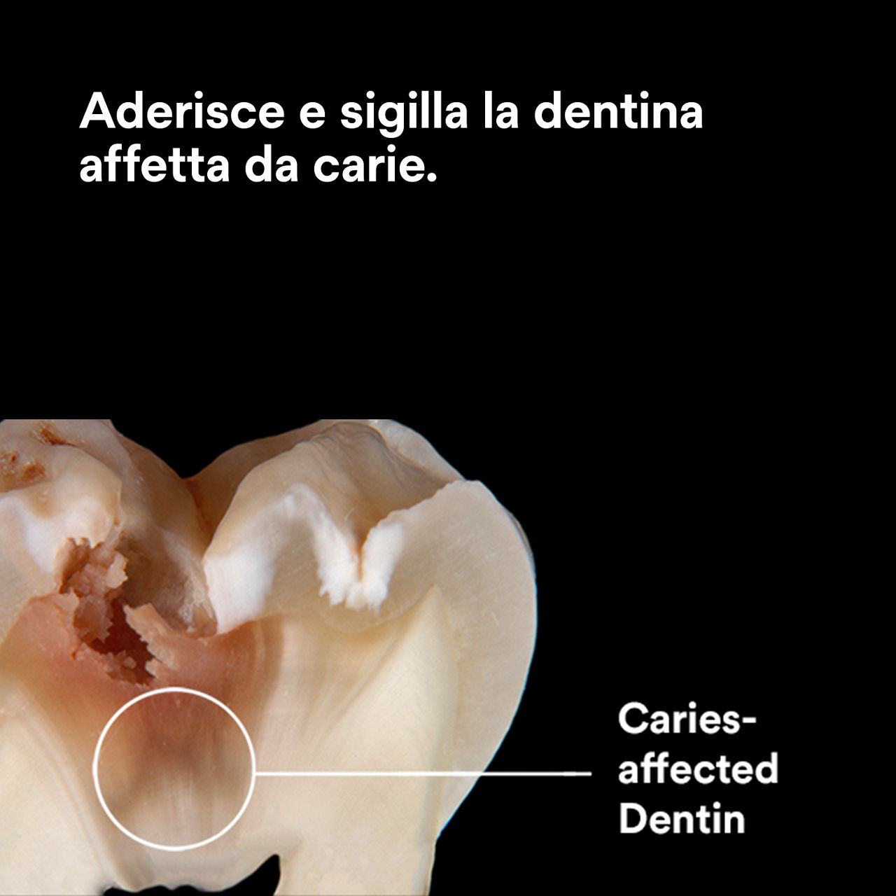 (3) Scotchbond Adesivo Universale Plus: Adesione e sigillatura della dentina affetta da carie