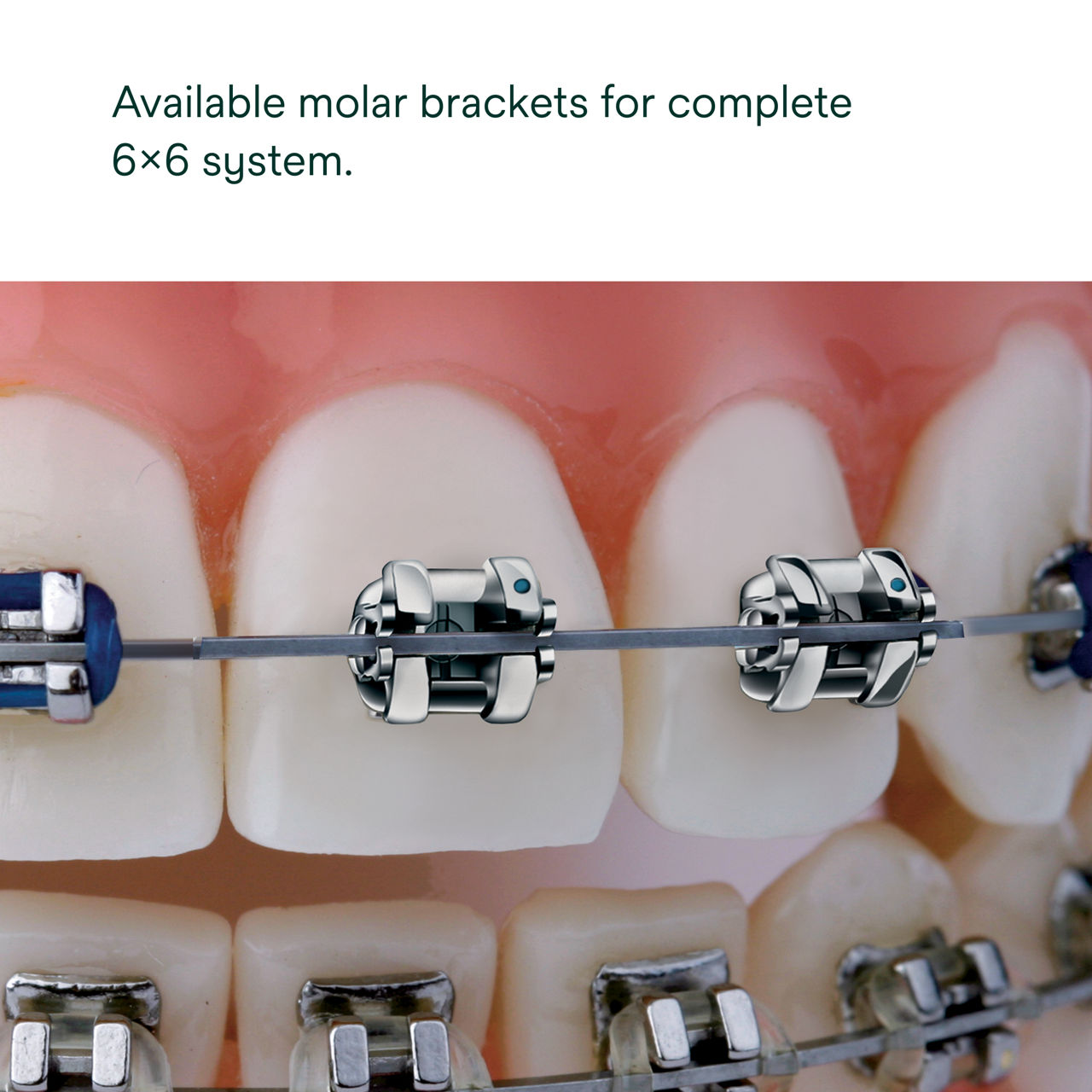 (3) Smartclip SL3 Brackets: available in molar brackets